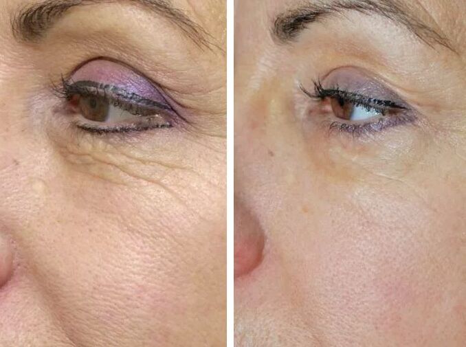 Laser polowy przed i po